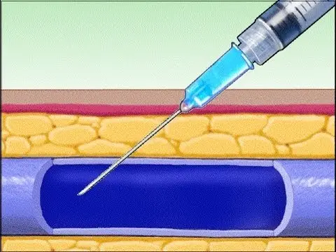 Intravenöse Injektion